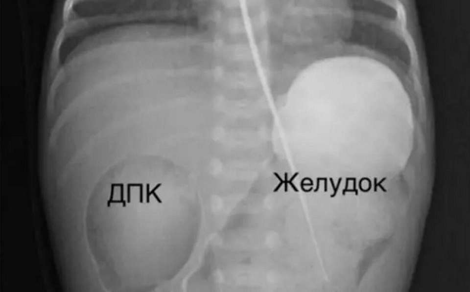 В Воронеже провели операцию новорожденной девочке с пороком развития кишечника