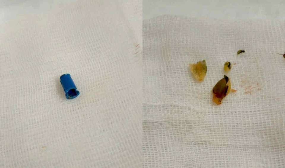 Деталь конструктора и семечку достали воронежские врачи из лёгких двух детей