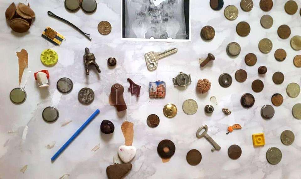 Воронежский врач рассказал о неожиданных предметах, что глотают дети