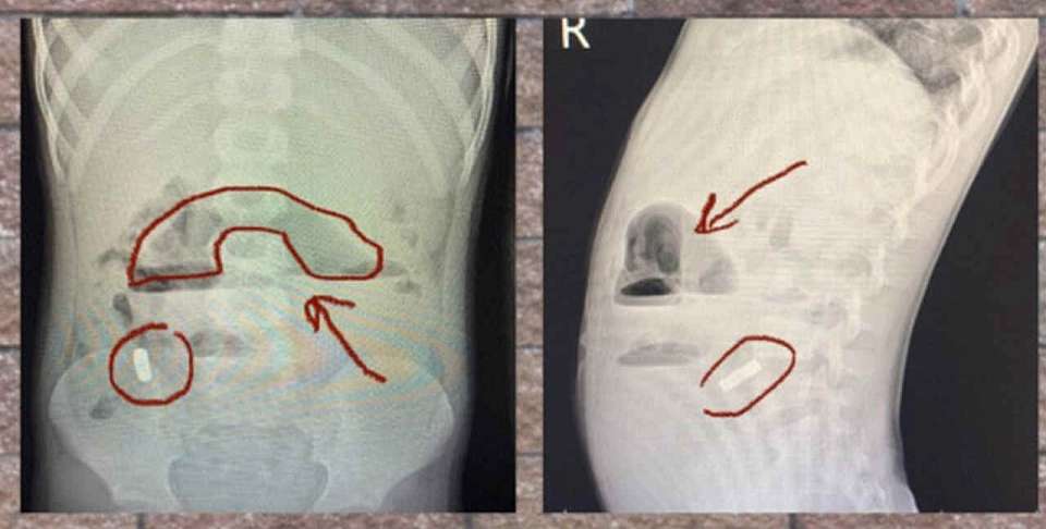 Из кишечника 6-летнего мальчика воронежские врачи удалили 10 магнитов