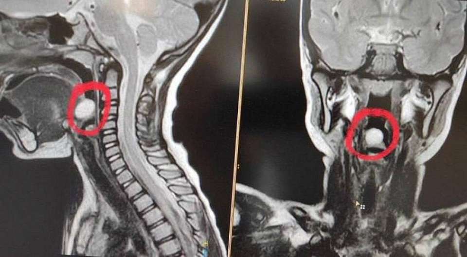 Уникальную операцию провели 5-летней девочке в воронежской больнице