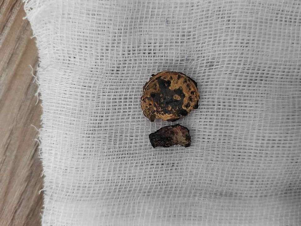 С куском металла в носу 5 лет жил воронежский подросток