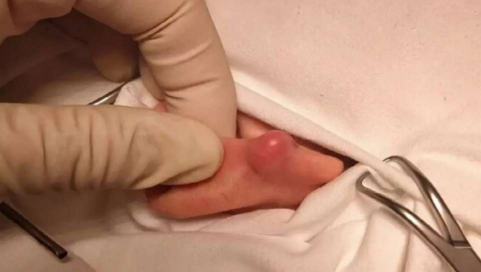 Редкое новообразование удалили врачи 15-летнему воронежцу