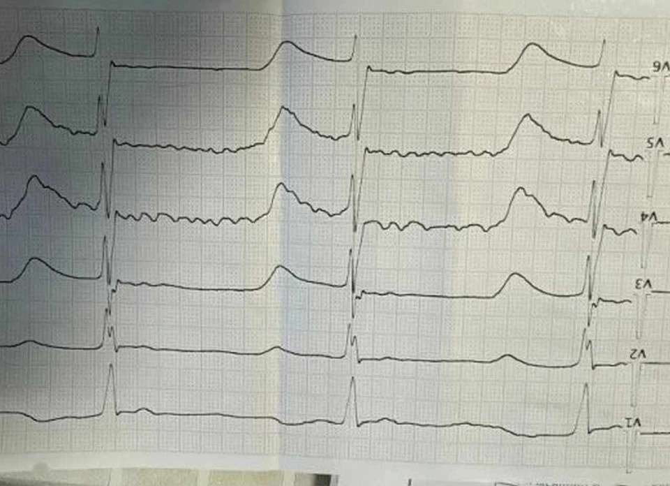 Воронежские врачи за сутки дважды запускали остановившееся сердце 64-летнего мужчины
