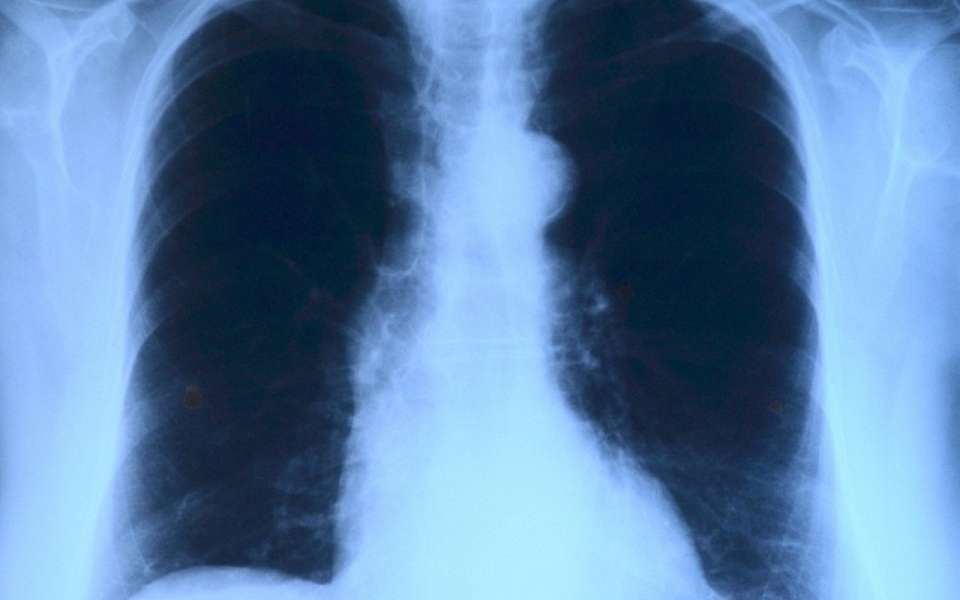 Насильно госпитализируют двух больных туберкулезом в Воронежской области