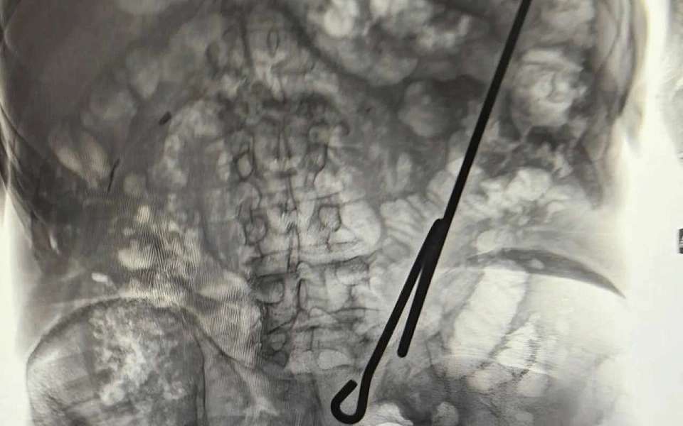 Из пациентов воронежские врачи достали длинного паразита и металлический крюк