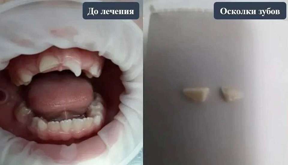 В Воронеже врачи восстановили зубы 7-летнему самокатчику