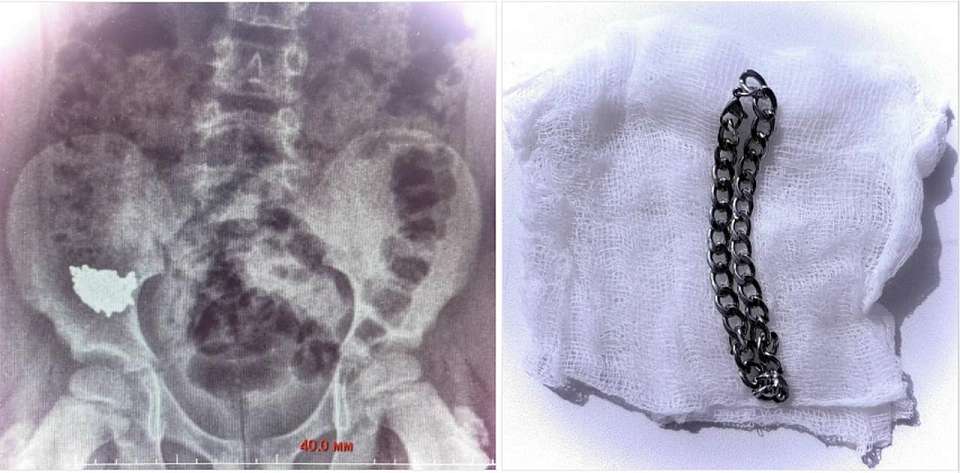 Воронежские врачи удалили проглоченную ребёнком 20-сантиметровую цепочку